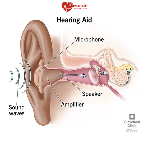 Lợi ích của việc sử dụng máy trợ thính